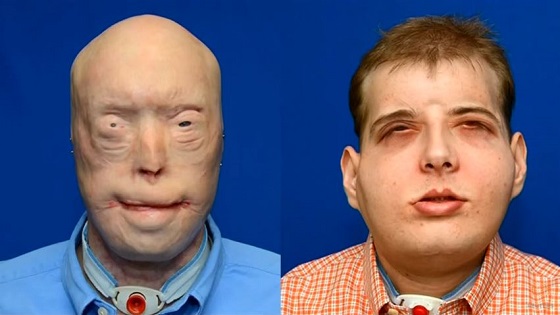 火事で顔が溶けた元消防士にイケメン選手の顔面を移植！　の画像3